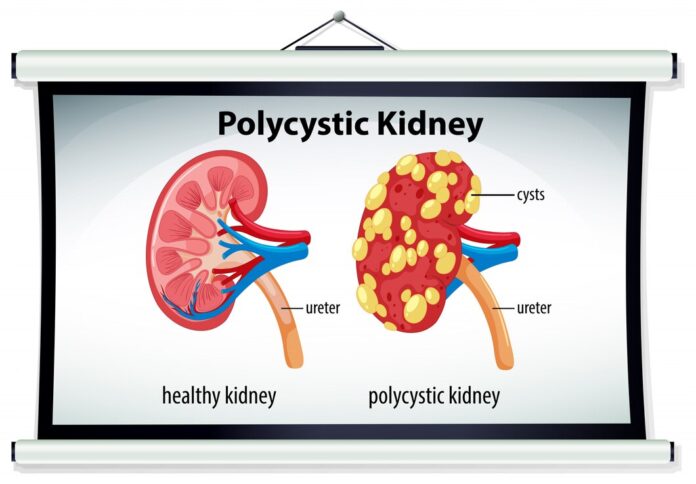 Polycystic kidney disease.